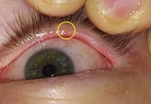 Göz İçinde Arpacık Belirtileri ve Tedavisi Göz İçinde Arpacık Belirtileri ve Tedavisi
