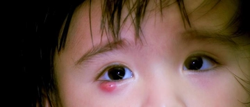 Çocuklarda Arpacık Belirtileri ve Tedavisi Çocuklarda Arpacık Belirtileri ve Tedavisi